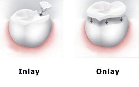 Dental Inlays Onlays
